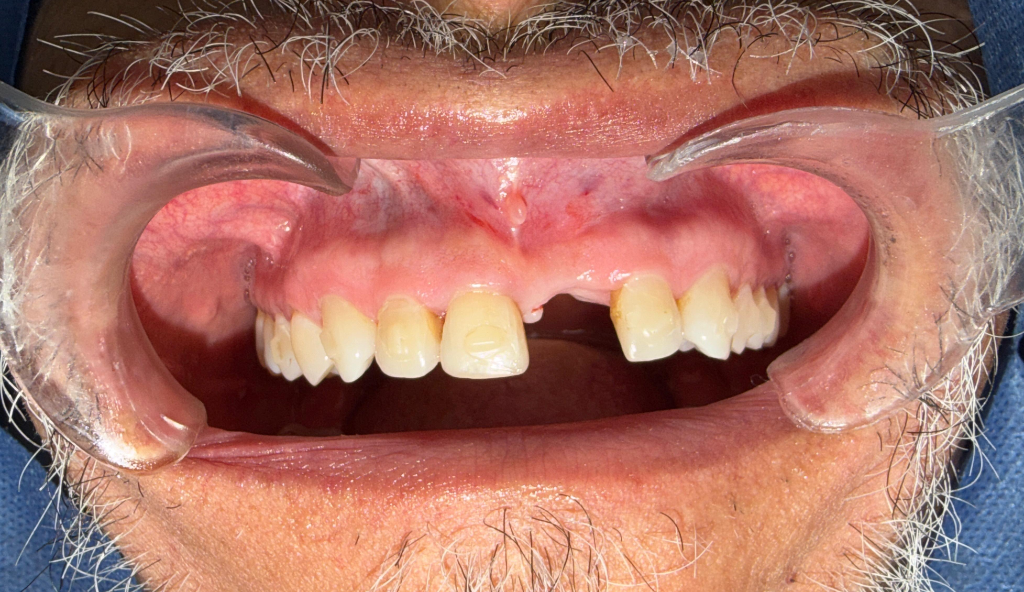 Caso 1 - Cirugía de Implantes - Dra. Ivanova Guerrero CDMX