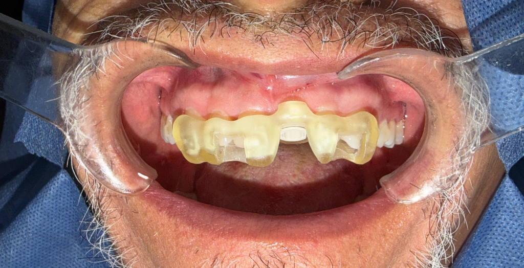 Caso 2 - Cirugía de Implantes - Dra. Ivanova Guerrero CDMX