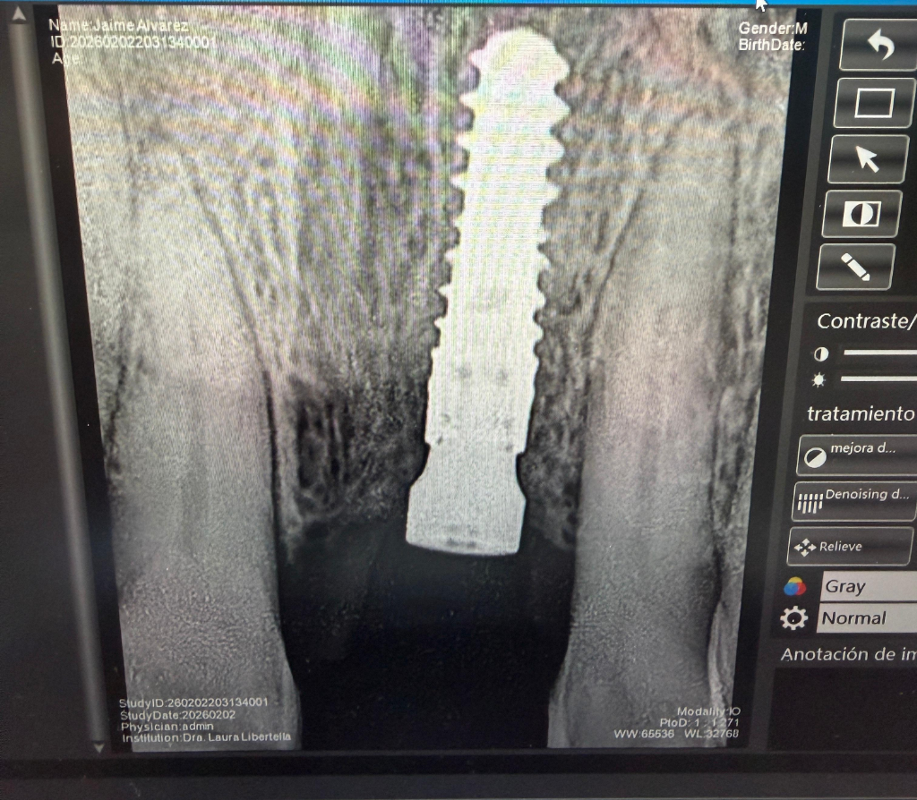 Radiografía - Cirugía de Implantes - Dra. Ivanova Guerrero CDMX