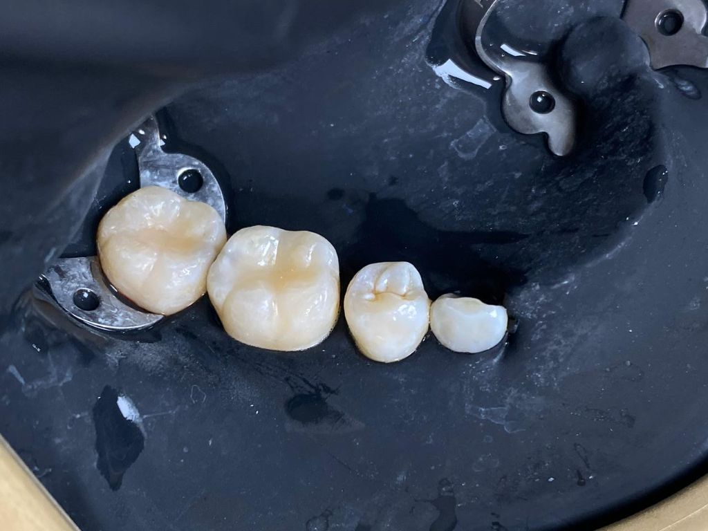 Después - Coronas Dentales - Dra. Ivanova Guerrero CDMX