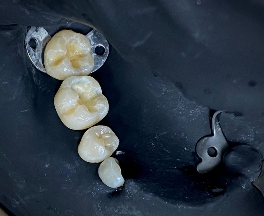 Proceso - Coronas Dentales - Dra. Ivanova Guerrero CDMX