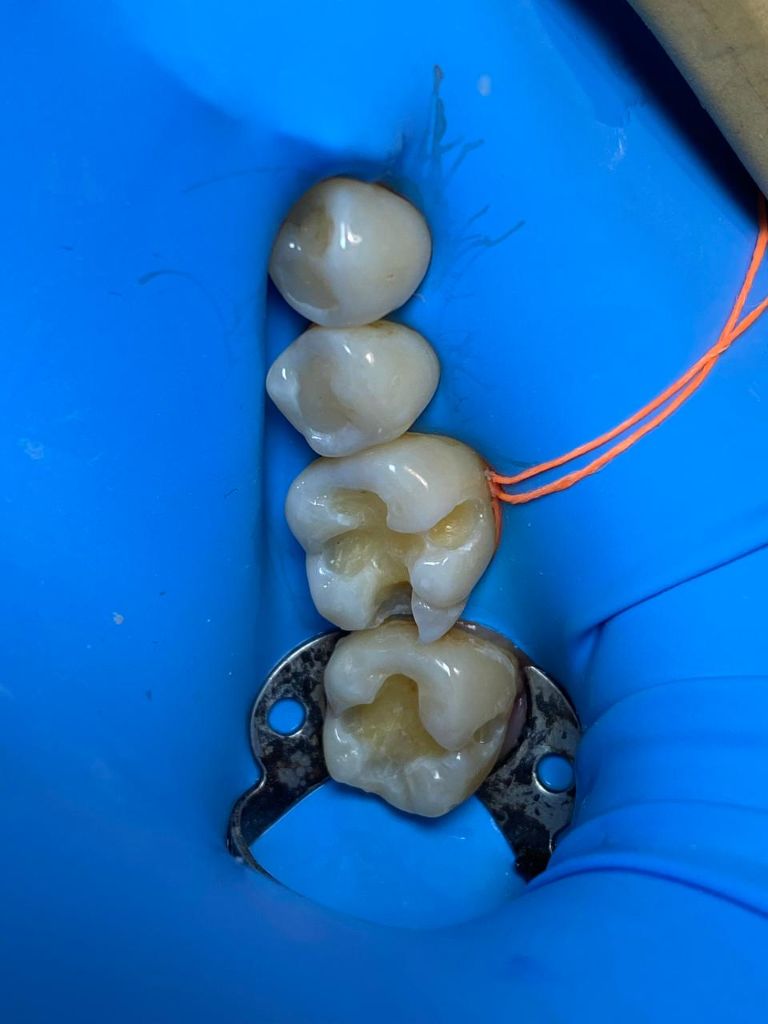 Antes - Rehabilitación en Resina Compuesta - Dra. Ivanova Guerrero CDMX